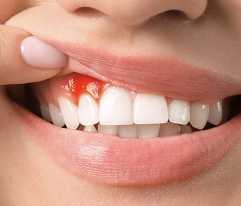 Viêm nhiễm khi bọc sứ chất lượng thấp không điều trị kịp thời dẫn đến viêm nha chu